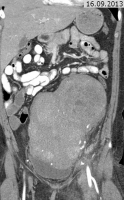 Abbildung 1: Vense Thromboembolie