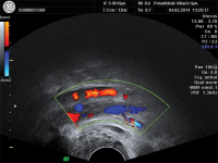Abbildung 3: Vense Thromboembolie