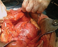 Abbildung 4: Uterus myomatosus