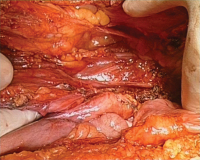 Abbildung 5: Uterus myomatosus