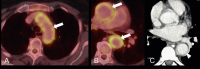Abbildung 1a-c: Riesenzellarteriitis