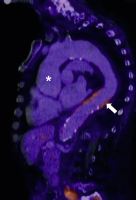 Abbildung 2: Riesenzellarteriitis