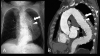 Abbildung 3a-b: Aorta thoracalis - Aortenruptur
