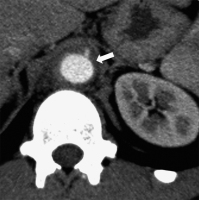 Abbildung 4: Aorta abdominalis - Pannus