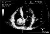 Abbildung 1: Nierenkarzinom - Tumorthrombose