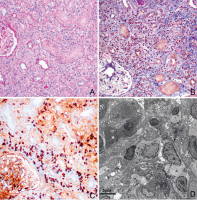 Abbildung 1A-D: Hyper-IgG-Syndrom