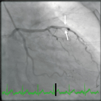 Abbildung 3: NSTEMI