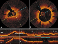 Abbildung 4a-c: Thrombus - Stent 