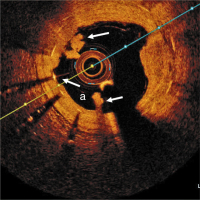 Abbildung 8: Thrombus