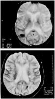 Figure 1: Zerebrale Blutung