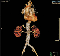 Abbildung 3: CT-Angiographie