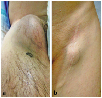 Abbildung 1a-b: Aneurysma