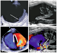 Abbildung 2a-d: Aneurysma