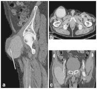 Abbildung 3a-c: Aneurysma