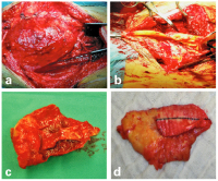 Abbildung 4a-d: Aneurysma