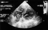 Abbildung 2: Nierenkarzinom - Tumorthrombose