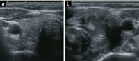 Abbildung 1a-b: Thyreoiditis