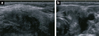 Abbildung 2a-b: Thyreoiditis