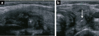Abbildung 3a-b: Thyreoiditis