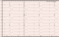 Abbildung 3: EKG