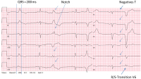 Abbildung 4: EKG