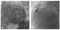 Abbildung 2a-b: Coronary Angiography