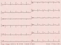 Abbildung 1: EKG