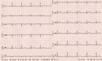 Abbildung 2: EKG