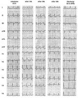 Figure 1: EKG - Trizyklika - Myokardinfarkt