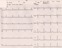 Abbildung 1: 12-Kanal-EKG