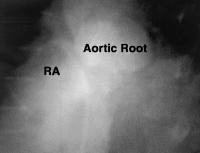 Figure 2: Sinus-Valsalvae-Aneurysma