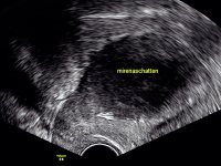 Abbildung 2: Ultraschall-Hormonspirale