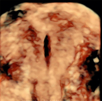 Abbildung 5: Ultraschall-Hormonspirale