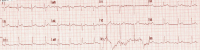 Abbildung 1: Prklinisches EKG