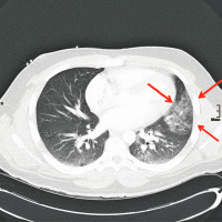 Abbildung 3: CT-Thorax