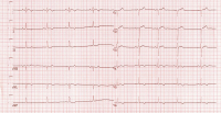 Abbildung 10: EKG