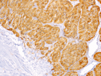Abbildung 9: Tumor
