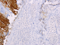 Abbildung 10: Tumor