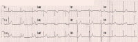 Abbildung 1: EKG