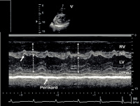 Abbildung 4: Pericarditis constrictiva