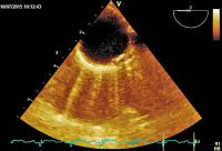 Abbildung 6: Plaque  - Aorta