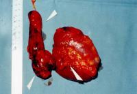 Abbildung 4: Nierenkarzinom - Tumorthrombose
