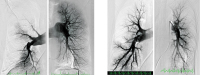 Abbildung 1a-b: Pulmonalgefangiographie