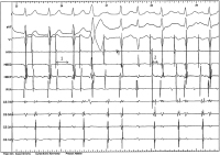Abbildung 2: EKG
