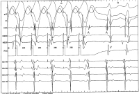 Abbildung 4: EKG