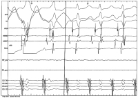 Abbildung 5: EKG
