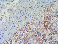Abbildung 1: Nierenzellkarzinom-Pathologie