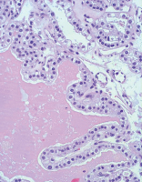 Abbildung 2: Nierenzellkarzinom-Pathologie