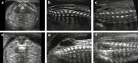 Abbildung 1a-f: Spina bifida  Prnataldiagnose