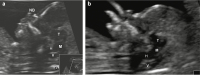 Abbildung 2a-b: Spina bifida  Prnataldiagnose